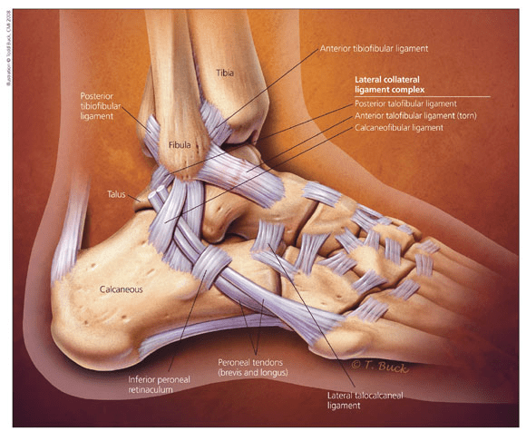 Lateral-Ankle-Sprain.png